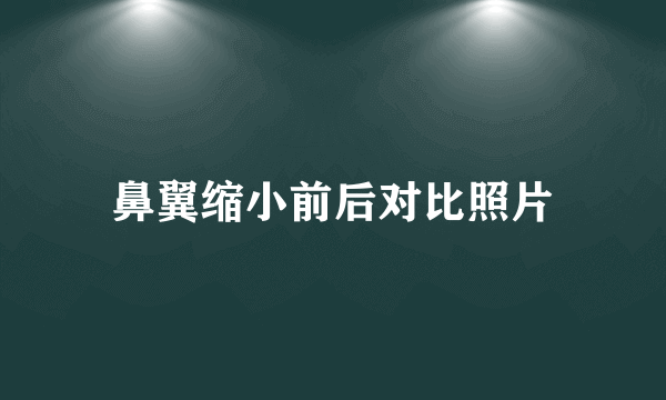 鼻翼缩小前后对比照片