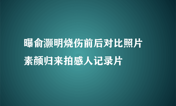 曝俞灏明烧伤前后对比照片 素颜归来拍感人记录片