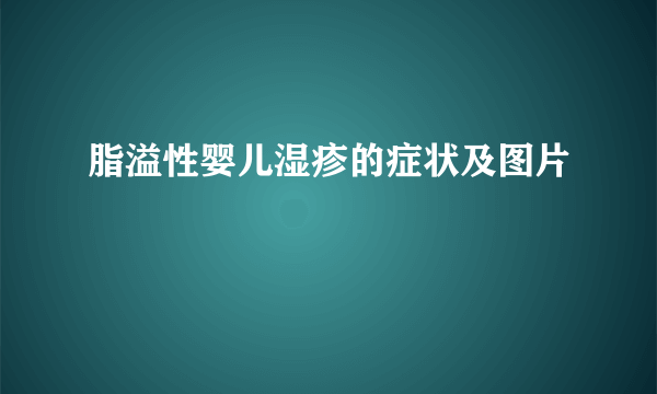 脂溢性婴儿湿疹的症状及图片