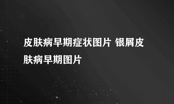 皮肤病早期症状图片 银屑皮肤病早期图片