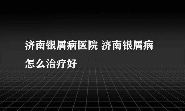 济南银屑病医院 济南银屑病怎么治疗好