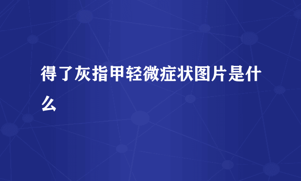 得了灰指甲轻微症状图片是什么